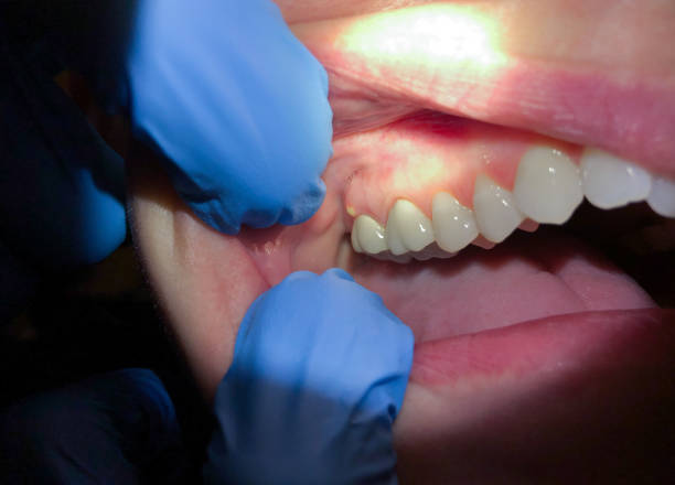 Best Emergency Root Canal Treatment in Glen Burnie, MD